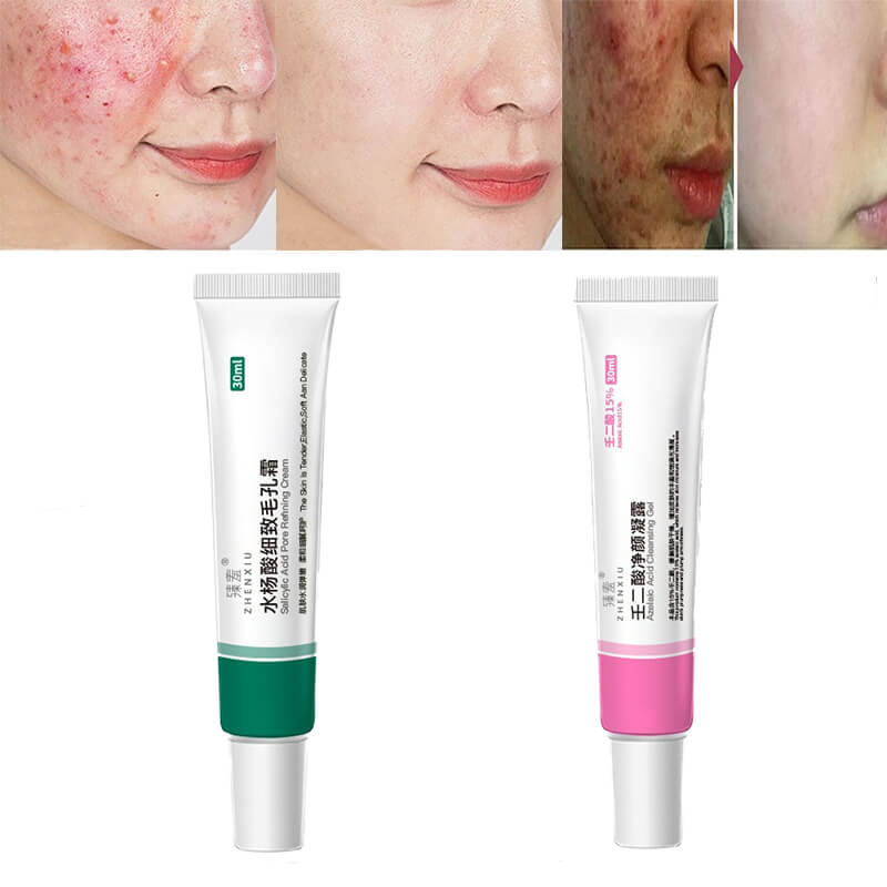 Salicylic Acid Cream  Oil Control Anti-Acne Face Cream
