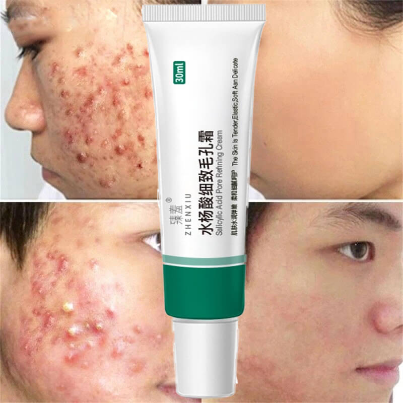 Salicylic Acid Cream  Oil Control Anti-Acne Face Cream